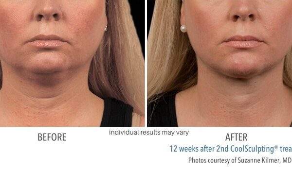 CoolSculpting Before and After 01