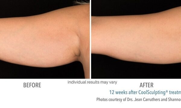 CoolSculpting Before and After 03