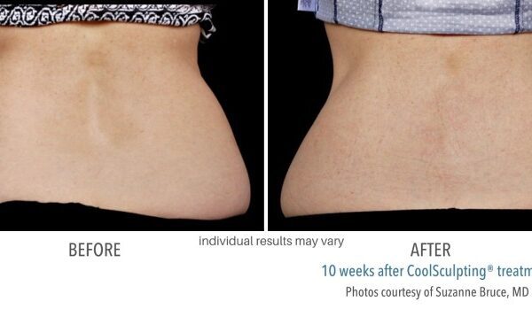 CoolSculpting Before and After 04