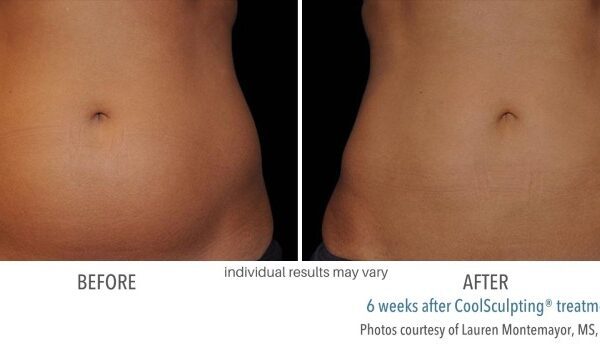 CoolSculpting Before and After 05
