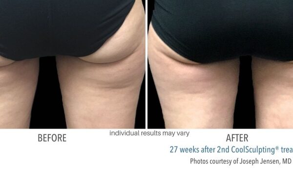 CoolSculpting Before and After 06
