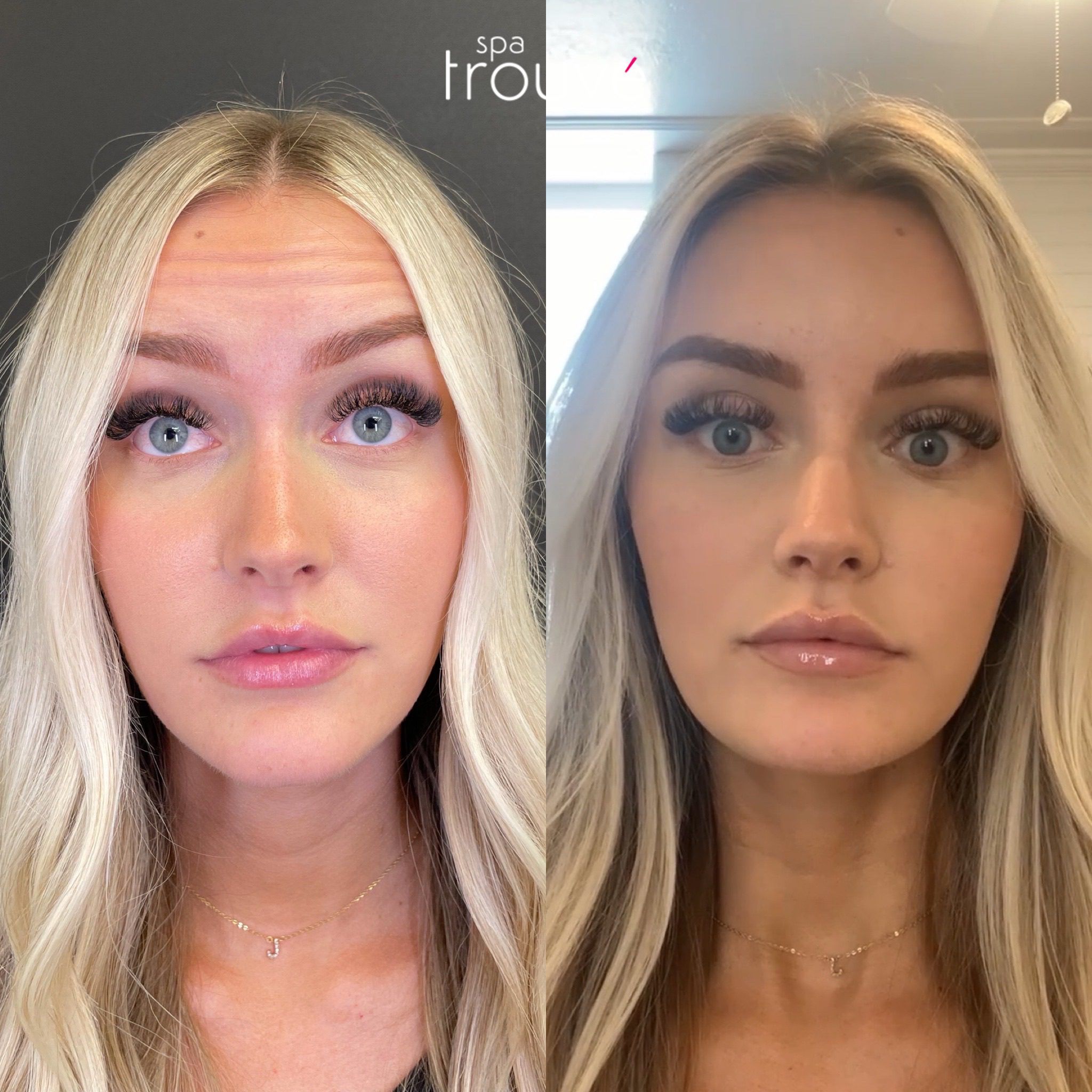 Before & After Photos of Utah Botox Injections
